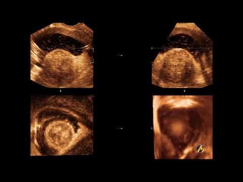 Rizični čimbenici za nastanak mioma