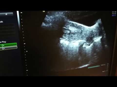 Ultrazvučno navođeni transfer embrija