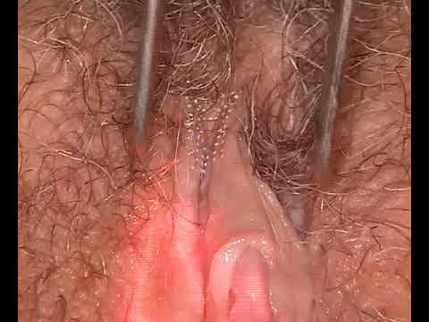 Laserska rejuvenacija intimnog područja u žena