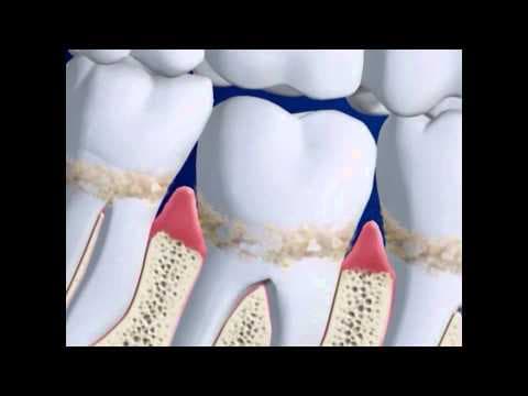 Periodontalne bolesti i težina novorođenčeta