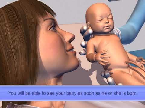 Više od polovice bolnica prelazi mjerila za porode carskim rezom