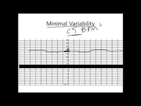 CTG bez opterećenja / NST - Non-stress test