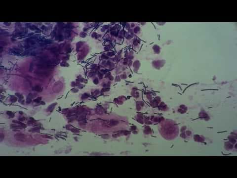 Sastav vaginalnih bakterija može predvidjeti prijevremeni porod