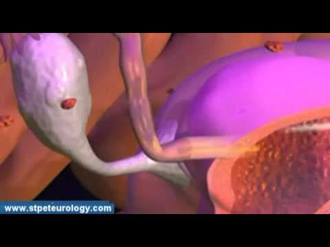 Ostali uzroci neplodnosti