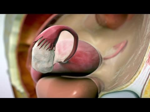 Vaginalna primjena danazola kod duboke endometrioze