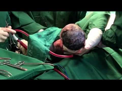 Planirani carski rez nema dugoročnu prednost nad nekompliciranim vaginalnim porodom blizanaca