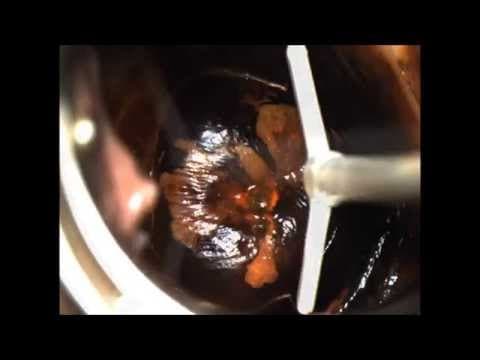 LETZ – poštedno rješenje abnormalnog PAPA testa