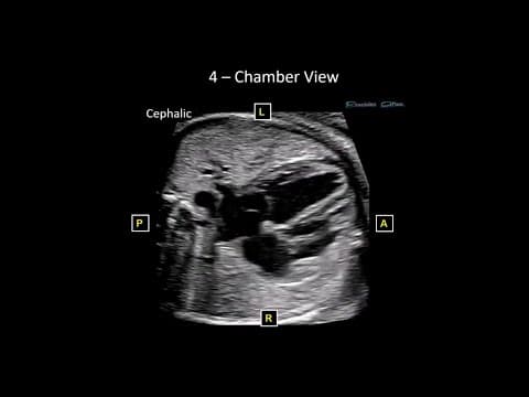 DiGeorge sindrom i prenatalna dijagnostika 22q11.2 delecije