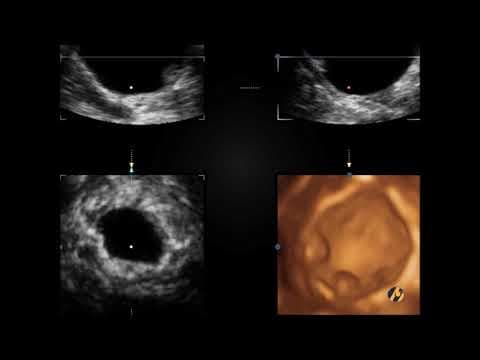 Ultrazvučna dijagnoza ginekološke ciste