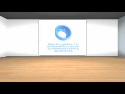 Cervikalni pesar može spriječiti prerani porod