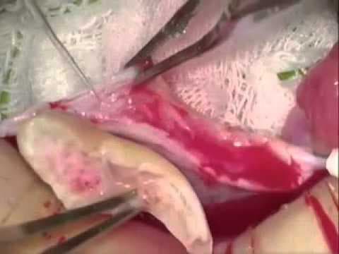 Transplantacija tkiva jajnika kao opcija za očuvanje plodnosti