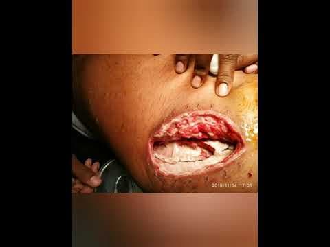 Odakle dolaze postoperativne infekcije?