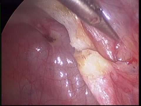 LUNA u liječenju dismenoreje