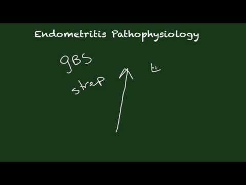 Teška postpartalna sepsa u porastu
