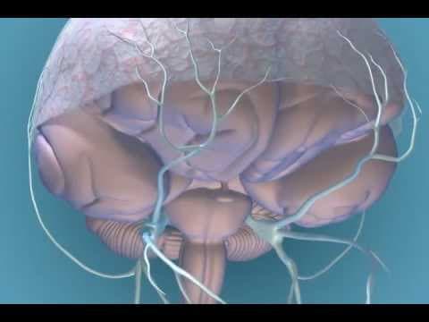 Pogoršanje migrene tijekom uzimanja HNL povezano s povećanjem rizika moždanog udara