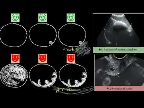 Ultrazvučna dijagnostika cista: GI-RADS i IOTA