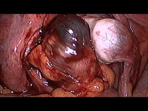 Resekcija crijeva kod endometrioze poboljšava plodnost u žena