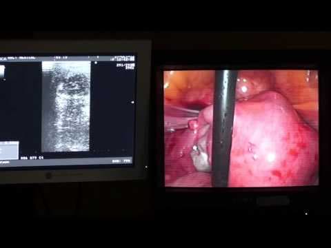 Nova tehnologija poboljšava simptome mioma
