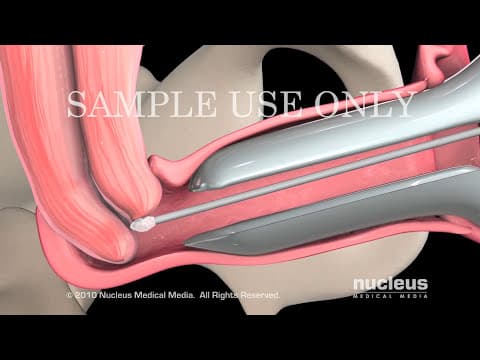 HPV test u praćenju CIN-a