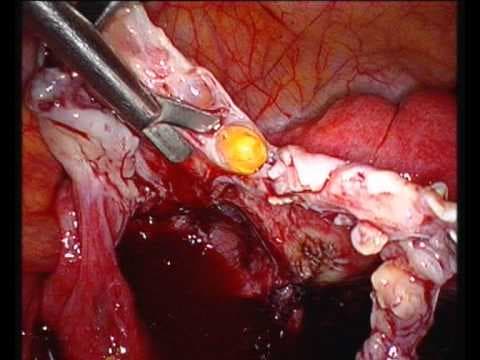 Endometrioidni tumori jajnika