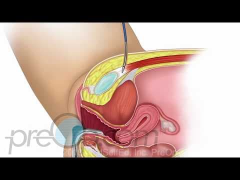 Vaginalni remen bez napetosti poboljšava seksualnu funkciju u žena sa stresnom inkontinencijom