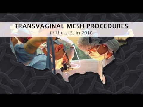 Smanjenje uporabe mrežice za korekciju prolapsa nakon upozorenja u 2011. godini
