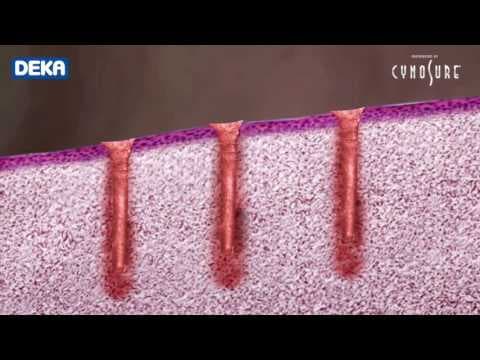 FDA odobrila "MonaLisa Touch" za liječenje vaginalne atrofije