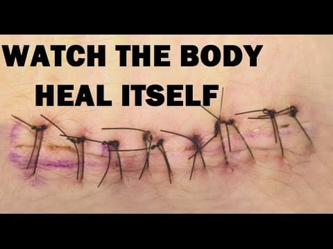 Zarastanje tkiva nakon laserskog zahvata labioplastike