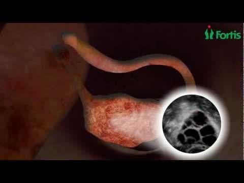 Metode potpomognute oplodnje