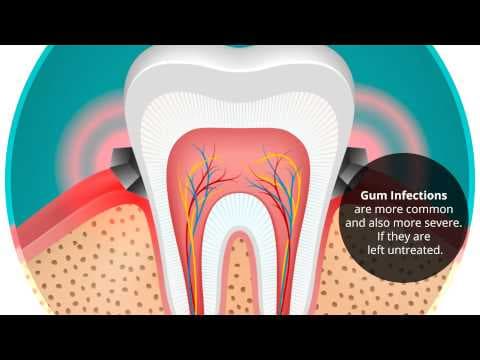 Često pranje zuba može umanjiti rizik od dijabetesa