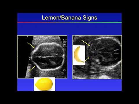 Fetalni MRI poboljšava dijagnostiku i prognozu anomalija mozga kod fetusa