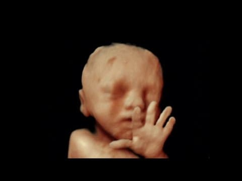 Kratak femur u 2. tromjesečju trudnoće i kromosomske abnormalnosti fetusa
