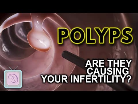 Polipi endometrija i neplodnost