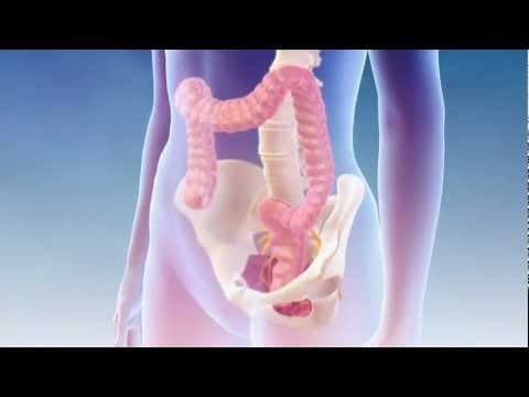 Mrežice obećavajuće u liječenju uporne fekalne inkontinencije