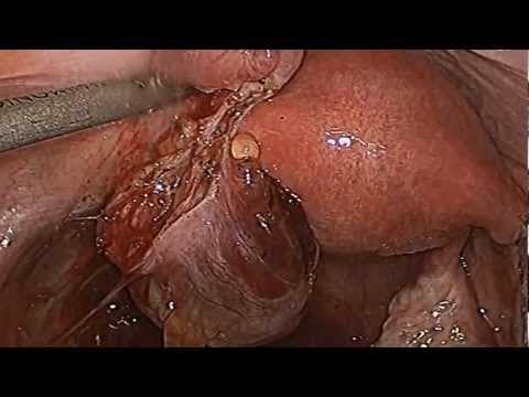 Salpingektomija ne utječe na funkciju jajnika