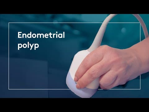 Treba li svaki endometrijski polip odmah odstraniti?