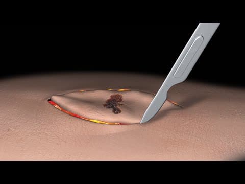 Valjanost PAPA testa s vulve: Poseban osvrt na lihen sklerozus