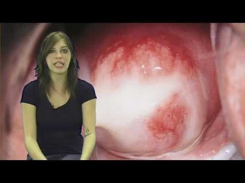 Doksiciklin bolji od azitromicina za klamidiju