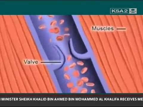 Venska tromboza i kontracepcija 3. generacije