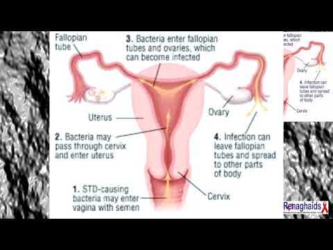Rizik zdjelične upalne bolesti je nizak uz IUD