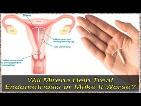 Endometrioza i "hormonska spirala"