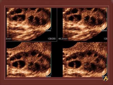 Policistični jajnici