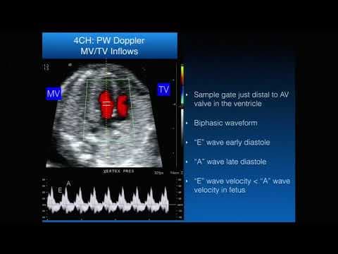 Prirođene srčane greške