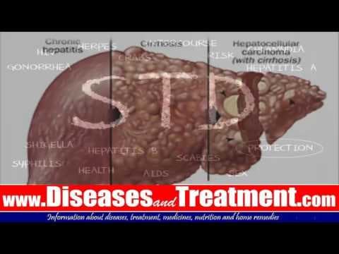 Pada stopa probira na klamidiju kod mladih žena