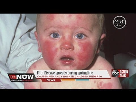 Parvo B-19 u trudnoći