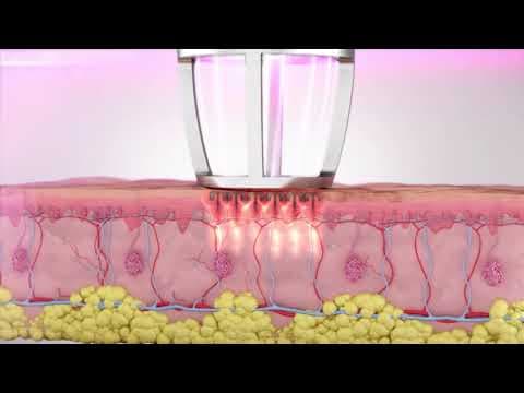 Novi standard u liječenju lihena sklerozusa vulve: Što žene trebaju znati