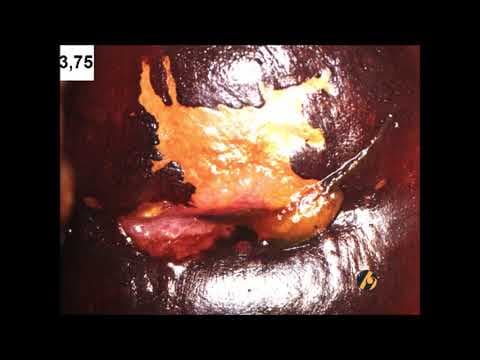 Abnormalni kolposkopski nalazi