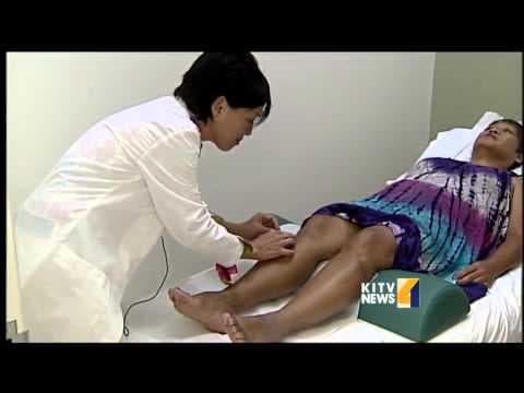 Akupunktura može ublažiti menopauzalne simptome koji su nuspojava lijekova za rak dojke