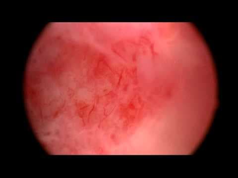 Histeroskopija prije IVF-a nije poboljšala stopu porođaja