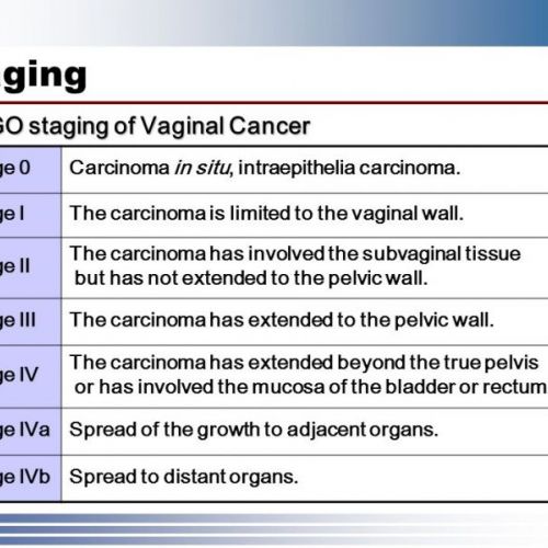 Stadiji karcinoma vagine